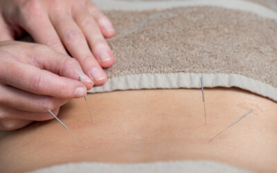 Acupuncture vs dry needling